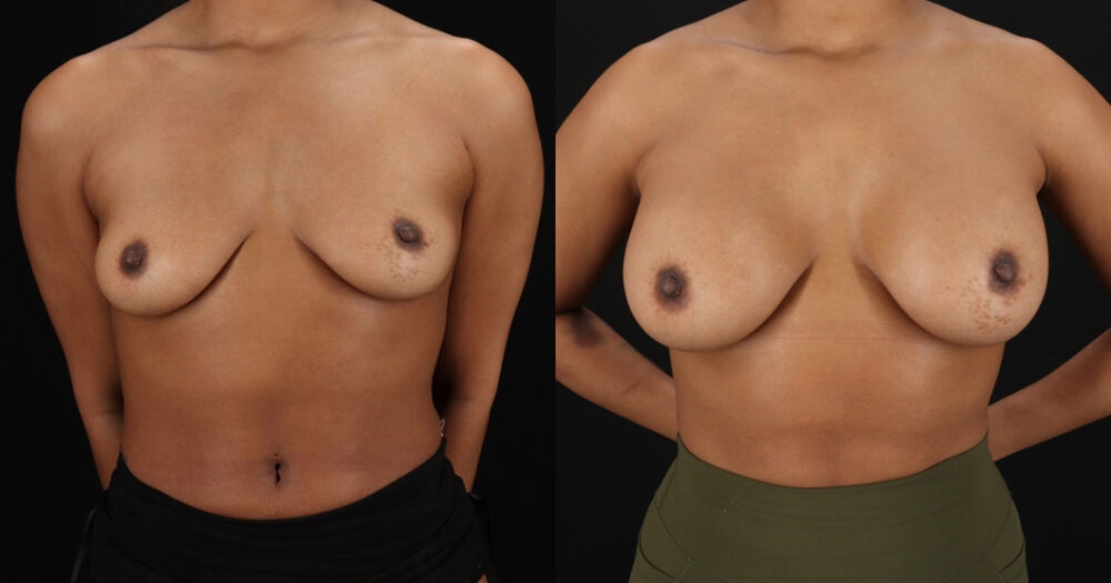 Breast Augmentation case #6390