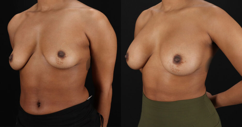 Breast Augmentation case #6390