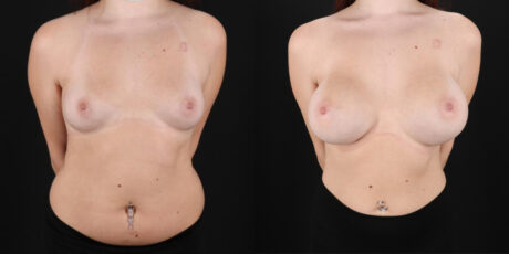 Breast Augmentation case #6396