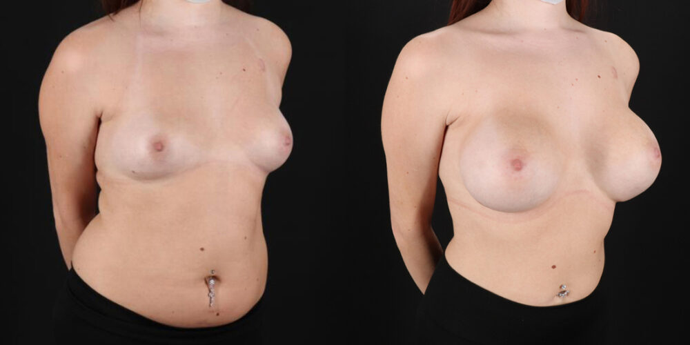 Breast Augmentation case #6396
