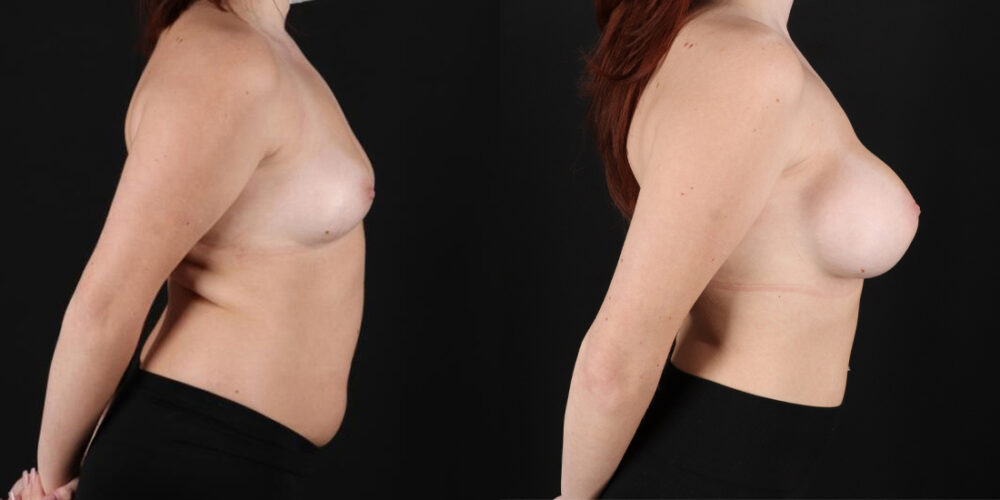 Breast Augmentation case #6396