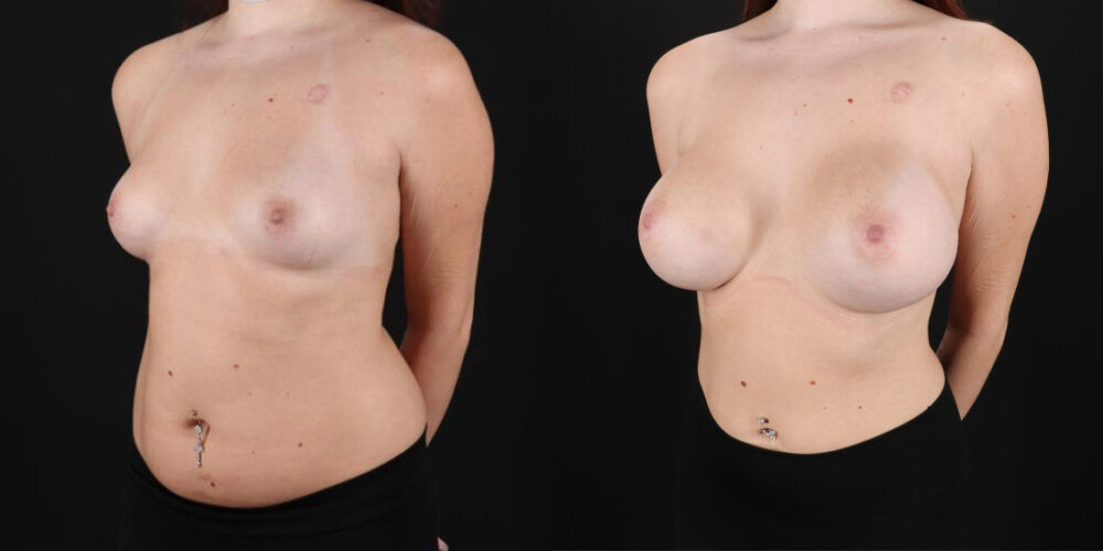 Breast Augmentation case #6396