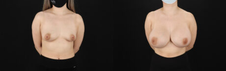 Breast Augmentation case #6402