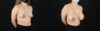 Breast Augmentation case #6402 slider thumbnail