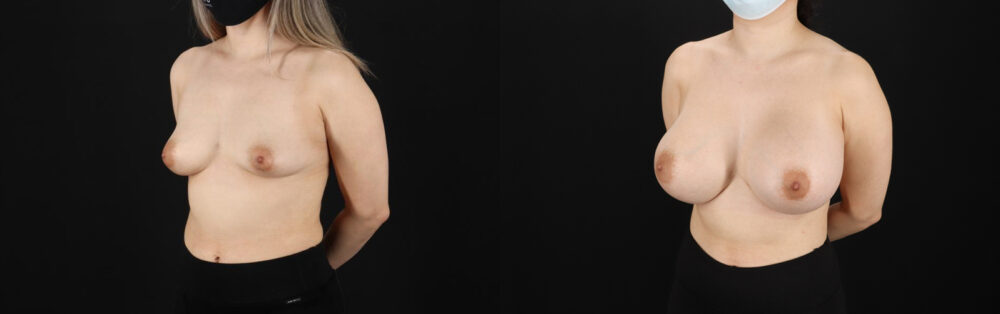 Breast Augmentation case #6402