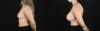 Breast Augmentation case #6402 slider thumbnail