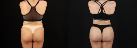 Brazilian Butt Lift case #5264