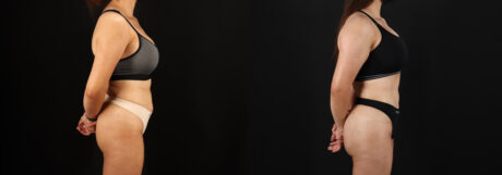 Brazilian Butt Lift case #5264