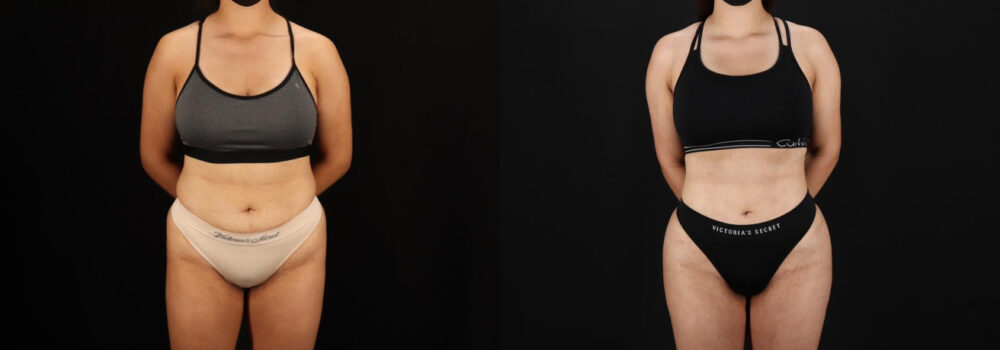 Brazilian Butt Lift case #5264