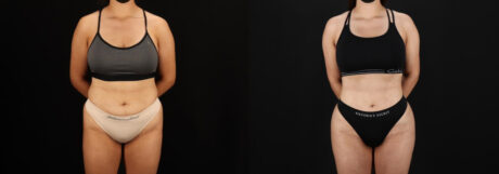 Brazilian Butt Lift case #5264