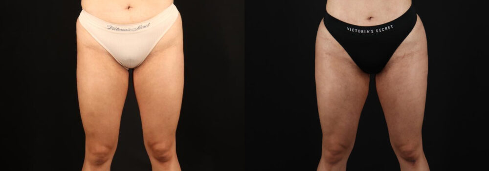 Brazilian Butt Lift case #5264