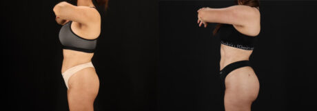 Brazilian Butt Lift case #5264