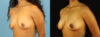 Fat Grafting to the Breast case #256207 slider thumbnail