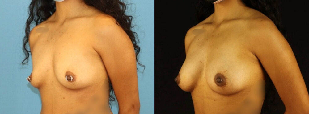 Fat Grafting to the Breast case #256207