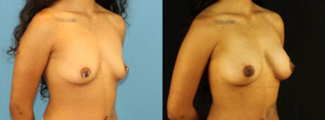 Fat Grafting to the Breast case #256207