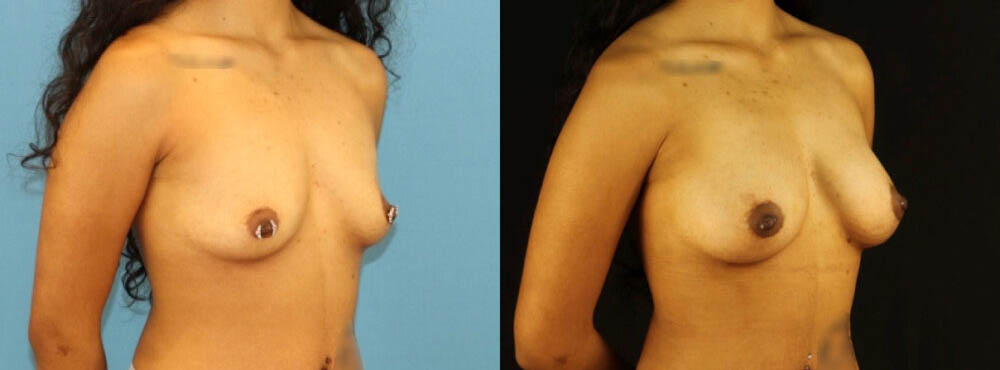 Fat Grafting to the Breast case #256207