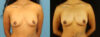 Fat Grafting to the Breast case #256207 slider thumbnail