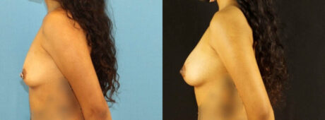 Fat Grafting to the Breast case #256207