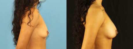 Fat Grafting to the Breast case #256207
