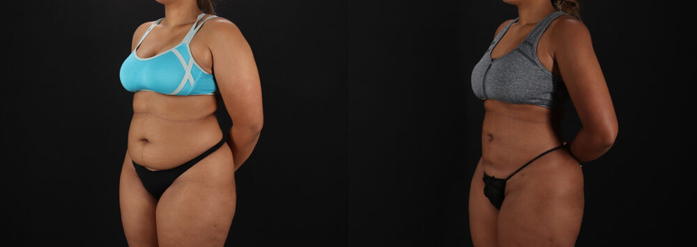 Brazilian Butt Lift case #5513