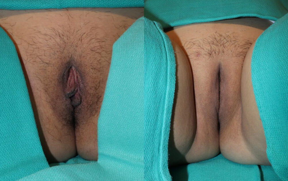 Labiaplasty case #5773