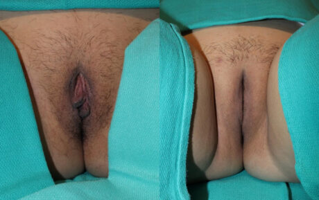 Labiaplasty case #5773