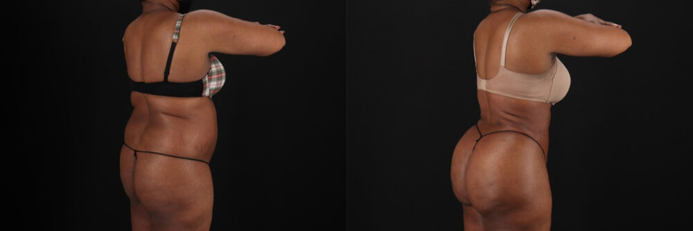 Brazilian Butt Lift case #5268