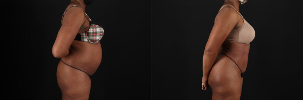 Brazilian Butt Lift case #5268