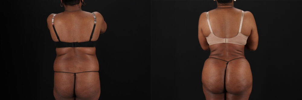 Brazilian Butt Lift case #5268