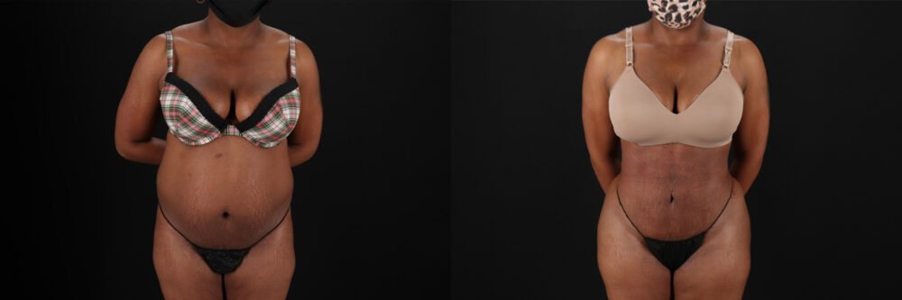 Brazilian Butt Lift case #5268