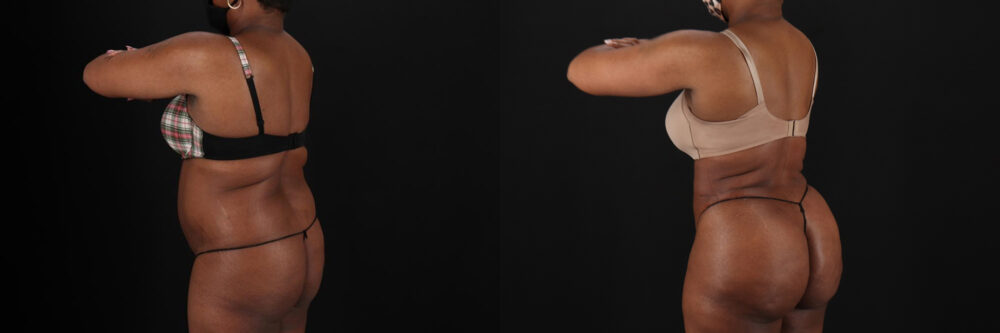 Brazilian Butt Lift case #5268