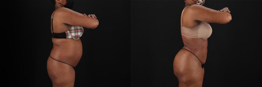 Brazilian Butt Lift case #5268