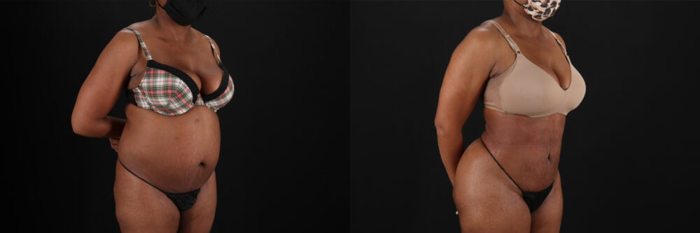 Brazilian Butt Lift case #5268