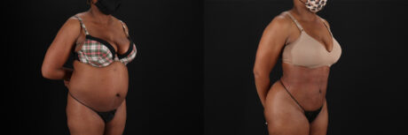 Brazilian Butt Lift case #5268