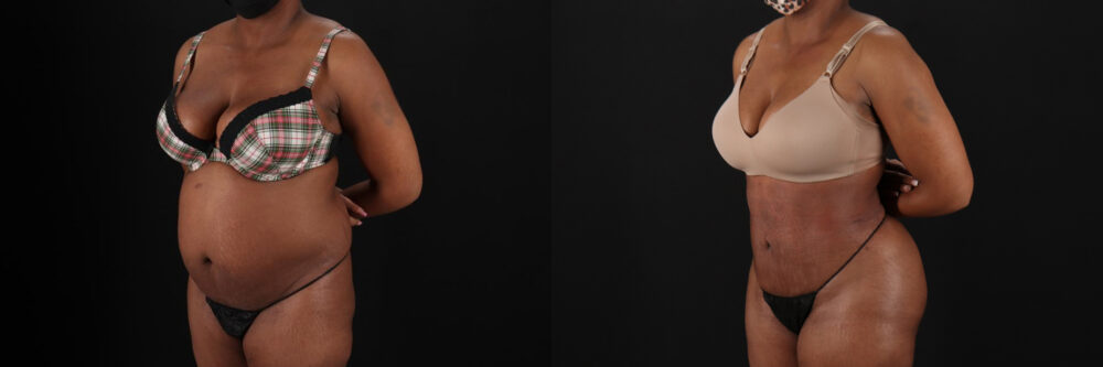 Brazilian Butt Lift case #5268