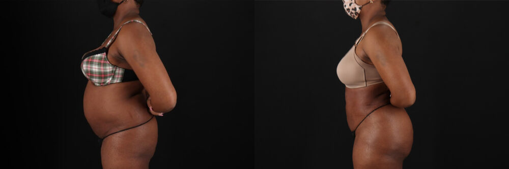 Brazilian Butt Lift case #5268