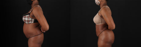 Brazilian Butt Lift case #5268