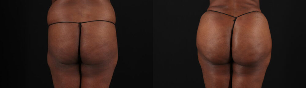 Brazilian Butt Lift case #5268