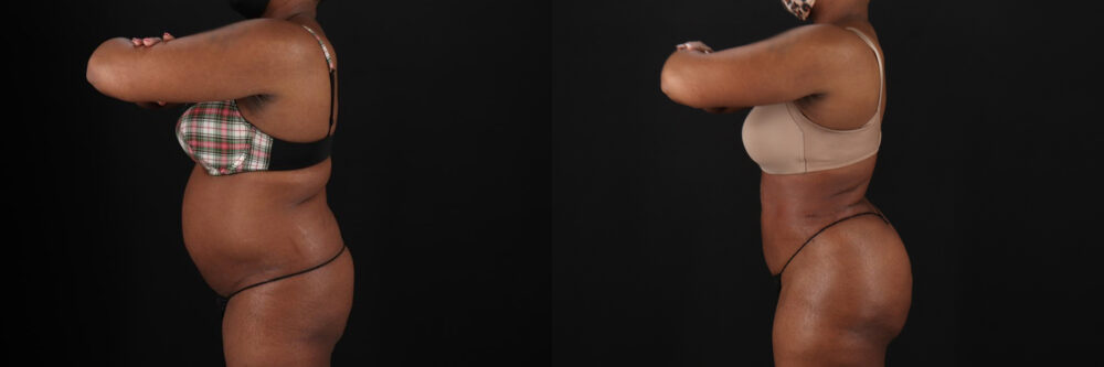 Brazilian Butt Lift case #5268