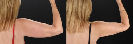 Liposuction case #6017