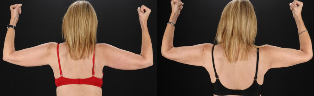 Liposuction case #6017