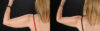 Liposuction case #6017 slider thumbnail