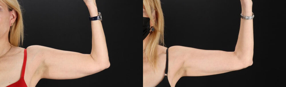 Liposuction case #6017