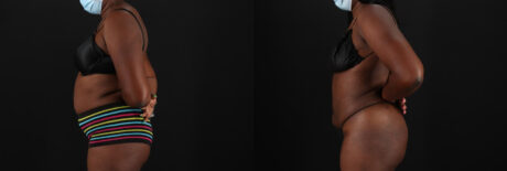 Liposuction case #6016