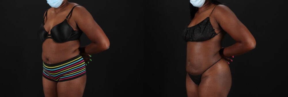 Liposuction case #6016