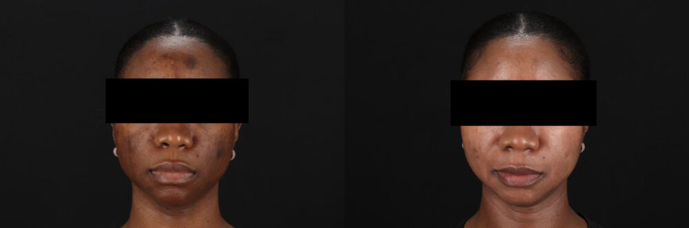 Cosmelan Chemical Peel case #5075