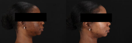 Cosmelan Chemical Peel case #5075