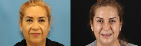 Botox® & Other Neuromodulators case #5051