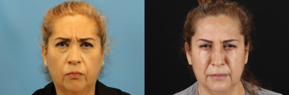 Botox® & Other Neuromodulators case #5051