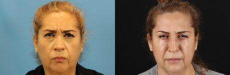 Botox® & Other Neuromodulators case #5051